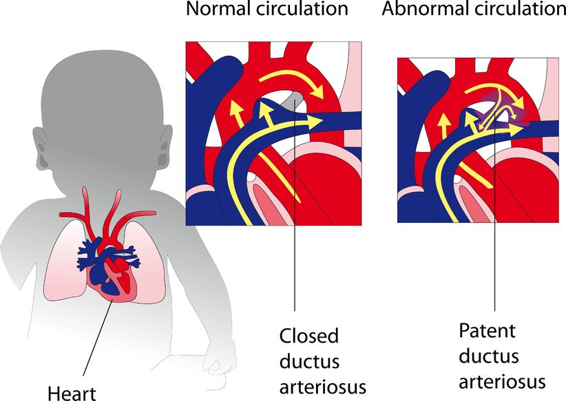 Patent Ductus Arteriosus The Patient Guide To Heart Lung And Esophageal Surgery